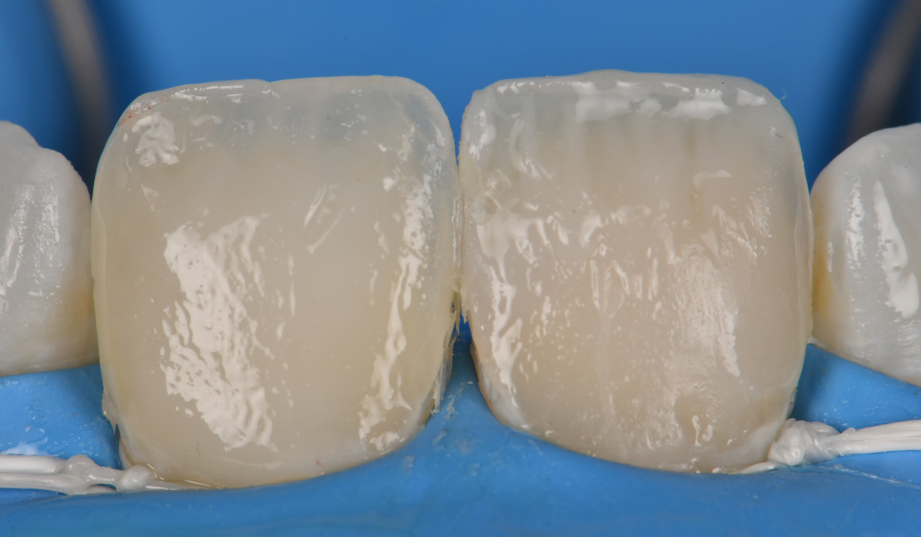 Figure 3: Tooth preparation with rotating instruments.